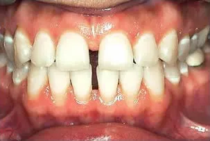 porcelain veneers smile two before