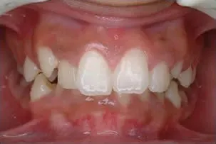 dental crowns before