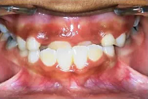 porcelain veneers smile one before