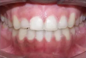 porcelain veneers smile two after