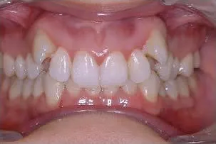 dental crowns before