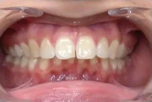 porcelain veneers smile two before